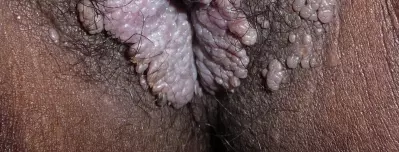 Vajina girişinin hemen altında siğiller